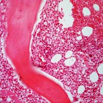 Treatment with venetoclax appears to be well-tolerated in patients with chronic lymphocytic leukemia or small lymphocytic lymphoma, says Nilanjan Ghosh, MD, PhD.