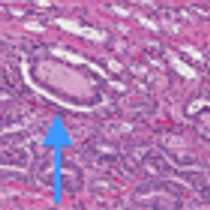 Adenocarcinoma of the Prostate