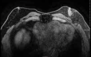 A 64-Year-Old Man With Germline BRCA2-Mutated Breast Cancer: Known and Unknown Aspects of Male Breast Cancer