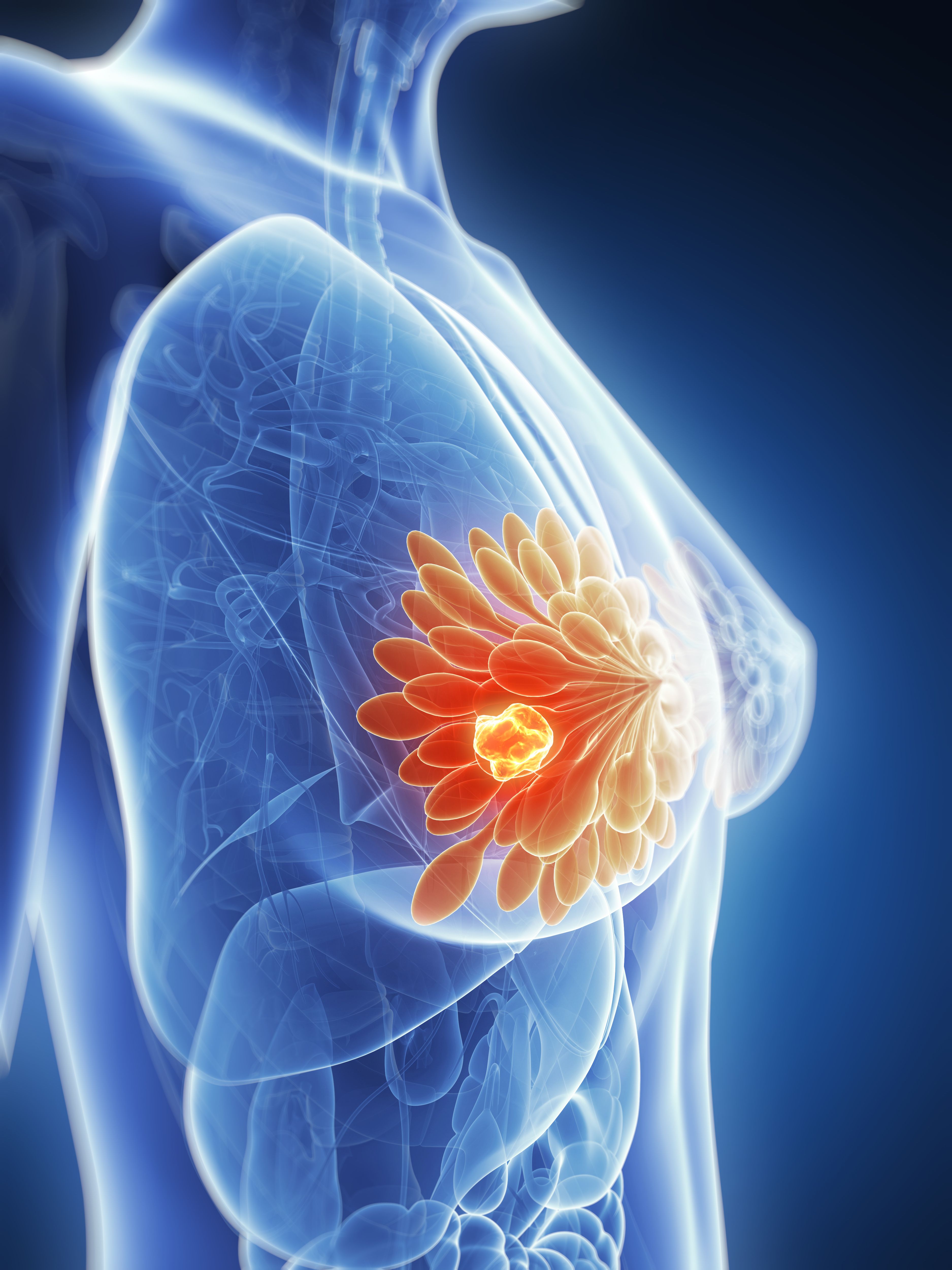 breast cancer