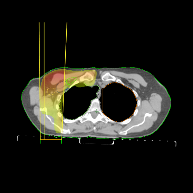 Slide Show: Advanced-Stage Breast Cancer | Cancer Network