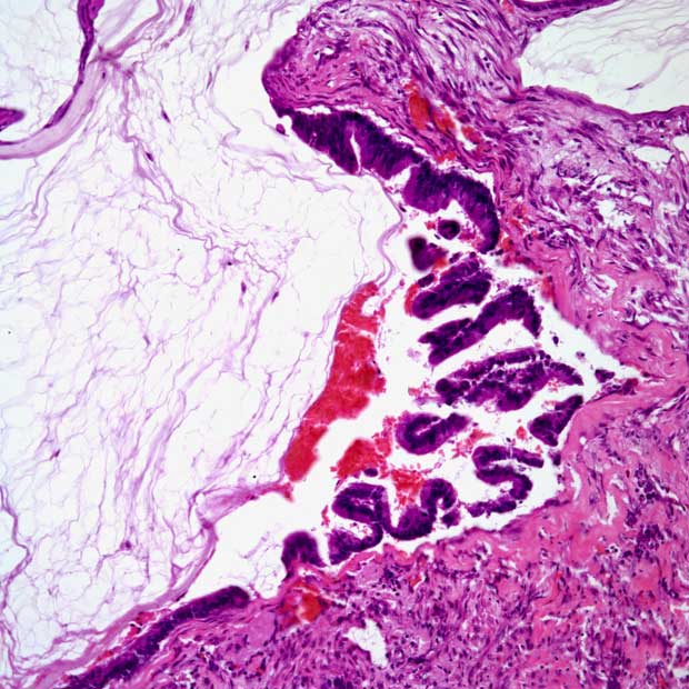 Findings from a retrospective analysis highlight no significant differences in metastasis-free survival in patients with muscle-invasive bladder cancer who received radical cystectomy vs trimodality therapy.
