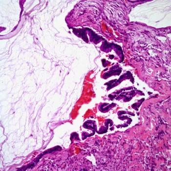 Findings from a retrospective analysis highlight no significant differences in metastasis-free survival in patients with muscle-invasive bladder cancer who received radical cystectomy vs trimodality therapy.