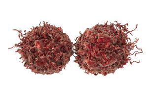 Radical Prostatectomy as Primary Treatment for Prostate Cancer Leads to Better Survival