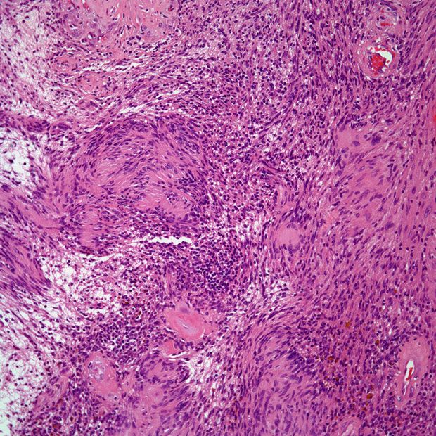 Posterior Mediastinal Mass Found in 47-Year-Old Patient | Cancer Network