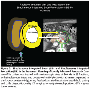 Improving Long-Term Survival in Patients With Locally Advanced Pancreatic Cancer via the Delivery of Definitive Radiotherapy Doses