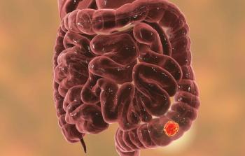 Updated results support nivolumab/ipilimumab as a standard of care in patients with MSI-H or dMMR metastatic colorectal cancer.