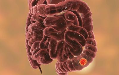 Ronald Bleday, MD, colorectal surgeon, touched upon his experience with an Enhanced Recovery after Surgery perioperative approach for pain management for patients with colorectal cancer.