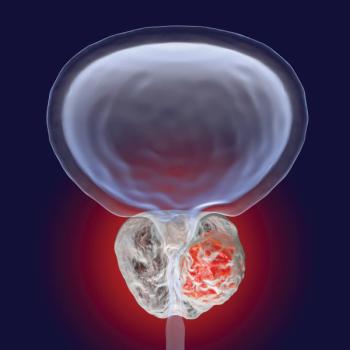 While metastasis-directed therapy has shown it may be a tool for prolonging PFS in other research, progression does still occur in most patients.