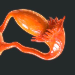 Stenoparib Receives FDA Fast Track Designation in Advanced Ovarian Cancer