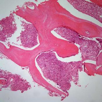 Asciminib may be more tolerable than bosutinib in the treatment of those with chronic myeloid leukemia, according to Michael Deininger, MD.