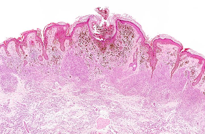 Treatment with isolated hepatic perfusion appears to yield improved progression-free survival compared with best alternative care in patients with isolated uveal melanoma liver metastases.