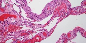 Olaparib plus temozolomide appears to prolong median progression-free survival for those with homologous recombination deficient uterine leiomyosarcoma compared with homologous recombination proficient tumors.
