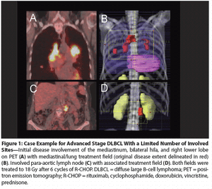 Improving Outcomes in Advanced DLBCL: Systemic Approaches and Radiotherapy 