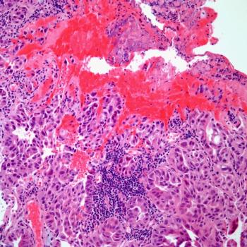 Investigators indicate that GEN-001 and avelumab does not have safety concerns in patients with advanced gastric or gastroesophageal junction adenocarcinoma.