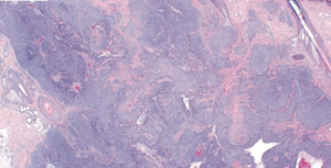 The complexity of carcinosarcoma