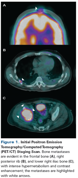 A Patient With Newly Diagnosed Metastatic Type 2 Papillary Renal Cell Carcinoma