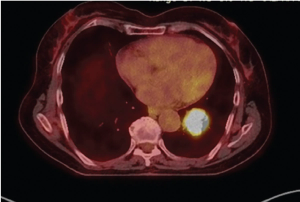 Neoadjuvant Capecitabine Plus Temozolomide in Atypical Lung NETs
