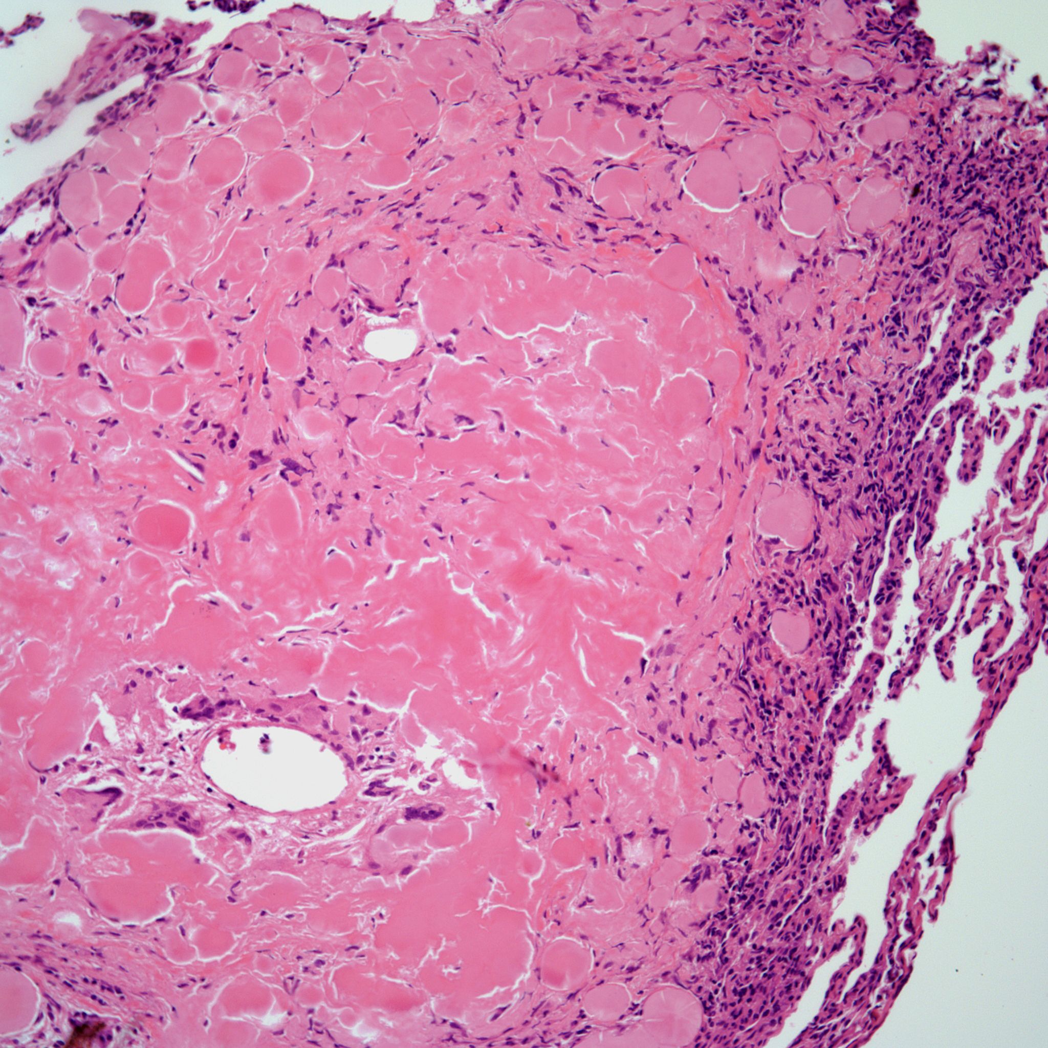 a-53-year-old-man-with-a-cough-chest-pain-and-dyspnea