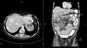 A 47-Year-Old Patient With Chronic Abdominal Pain