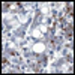 A Young Woman With Multiple Kidney Lesions