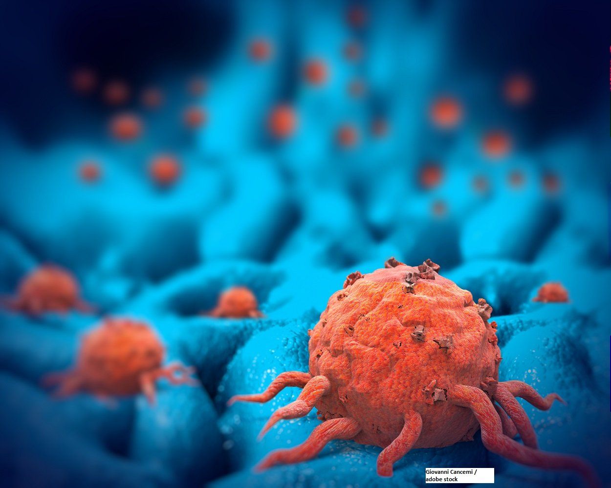 How Does Prognosis of NETs Differ Based on Site of Origin?