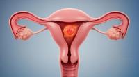 The gynecologic oncology data to watch at ESMO 2026: © Jenjira - stock.adobe.com