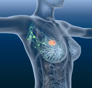 Francesco Ravera, MD, PhD, on How cfDNA for pCR Assessment May Spare Biopsies in Breast Cancer