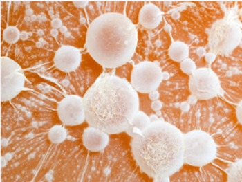 Cervical cancer poses additional challenges during pregnancy