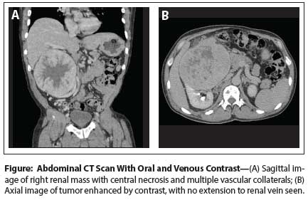 Large Renal Mass A Challenge For The Urologist Cancer Network