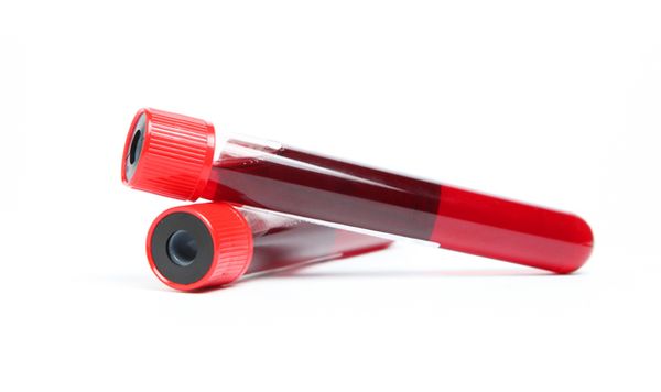 Updated NCCN Guidelines for multiple myeloma add a dedicated MRD testing framework and expand recommended MRD assessment timepoints.