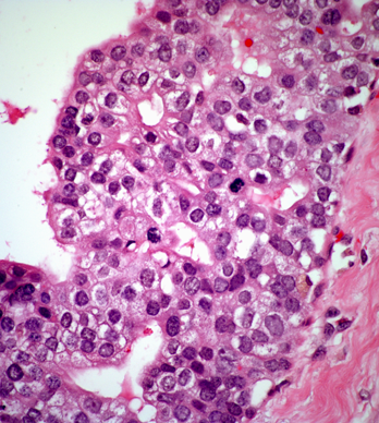 High magnification of ductal carcinoma in situ