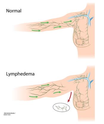 lymphedema, breast cancer