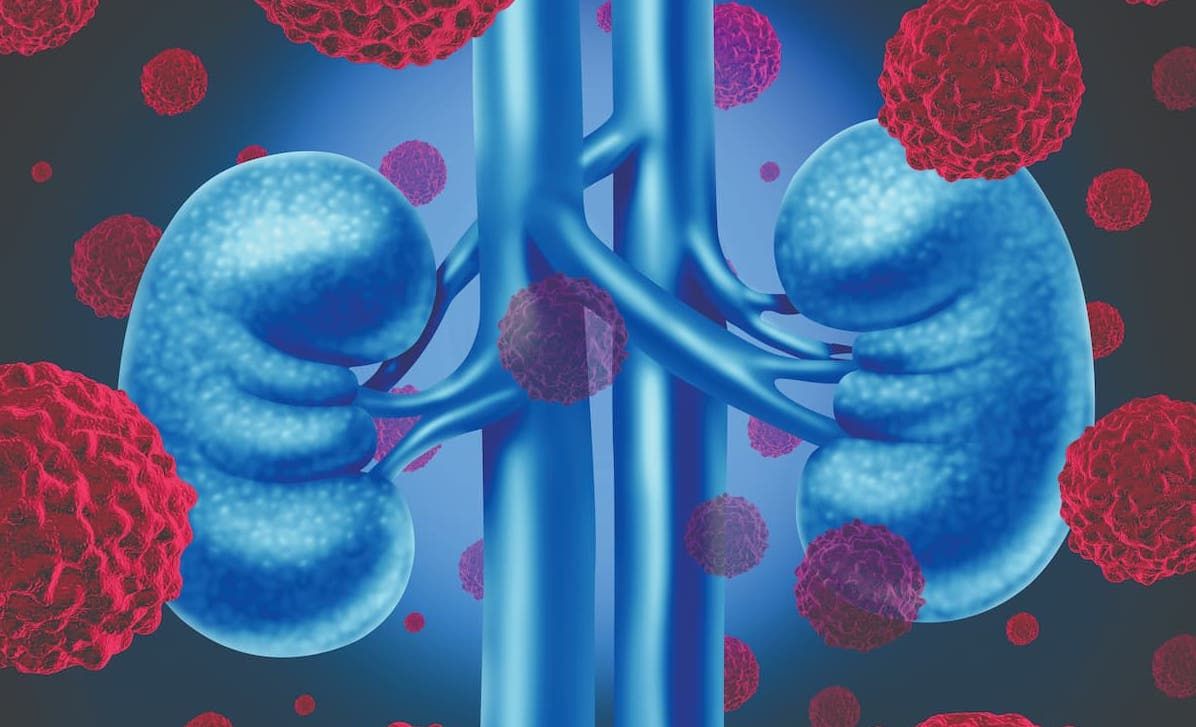 Disease-Free Survival Benefits Persist With Adjuvant Pembrolizumab in RCC