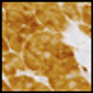 Response to Antiangiogenesis Therapy in a Patient With Advanced Adult-Type Testicular Granulosa Cell Tumor