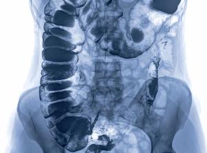 Clinical Trials in Progress: COBRA