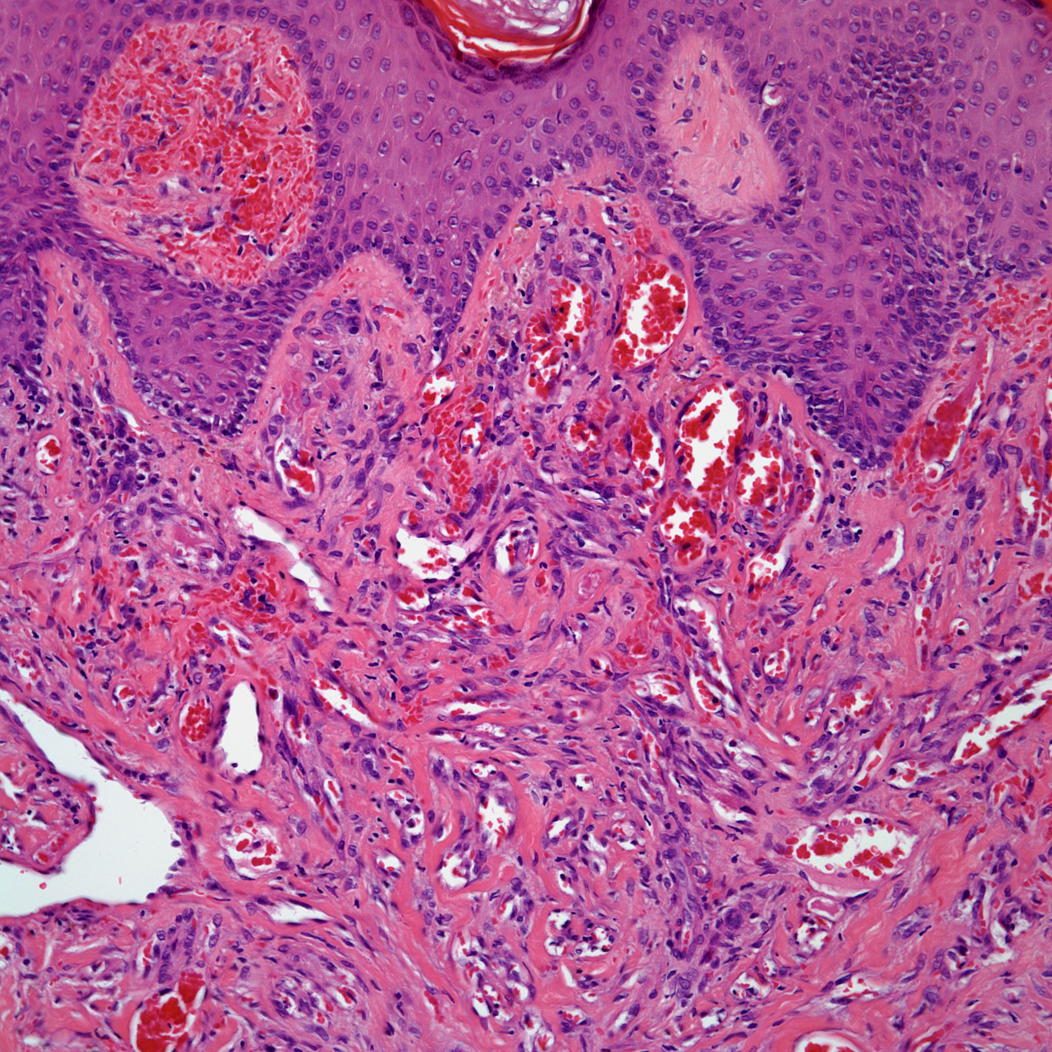 Diagnose This 58-Year-Old Man With Purpuric Nodules | Cancer Network