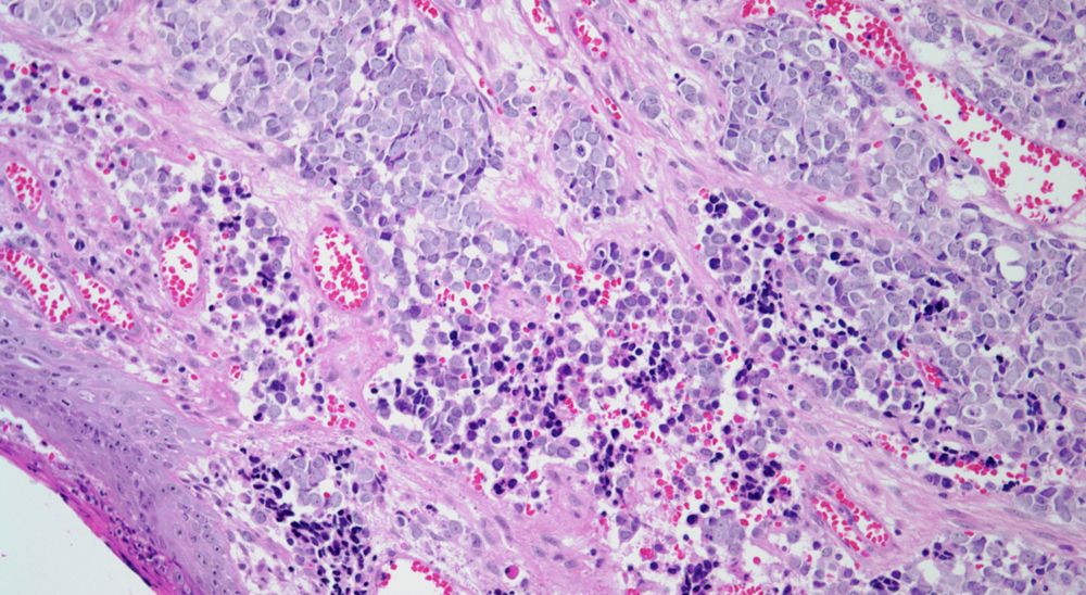 skin-mass-on-leg-of-56-year-old-patient-cancer-network