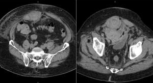A 60-Year-Old Patient Presents With Acute Abdominal Pain