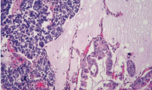 Patients With Extrapancreatic NETs Experience Improved PFS from Cabozantinib