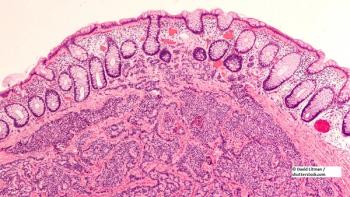 neuroendocrine tumors, NETs, liver, metastasis
