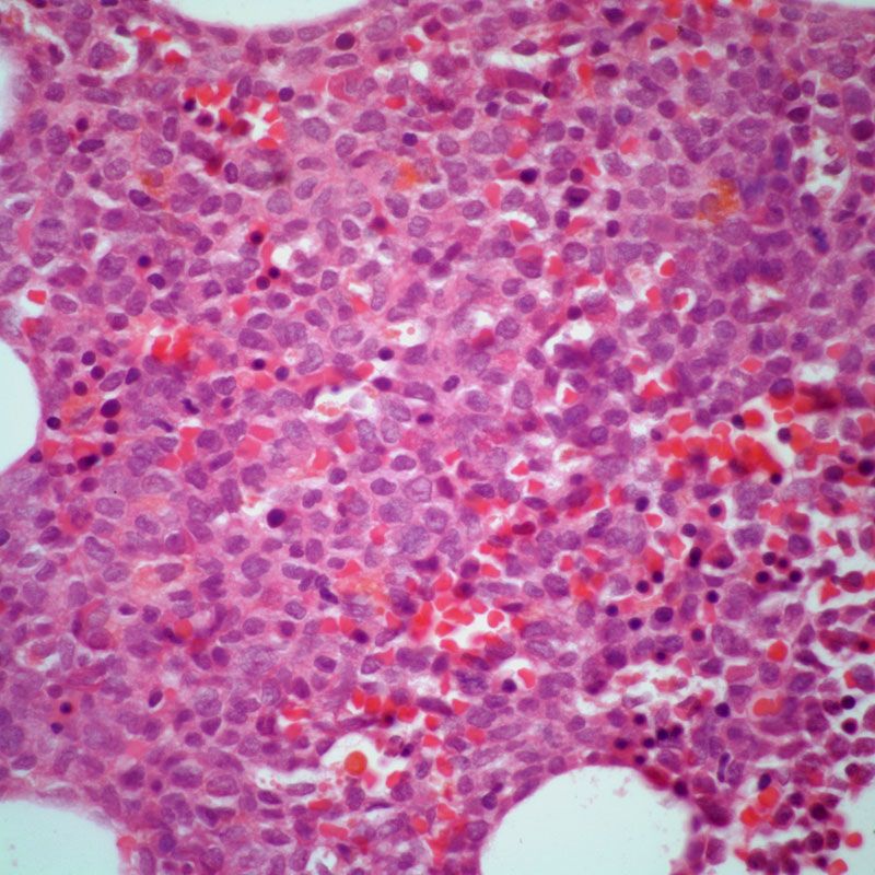 Gilteritinib Appears To Yield Encouraging Responses In Newly Gilteritinib Appears To Yield Encouraging Responses In Newly