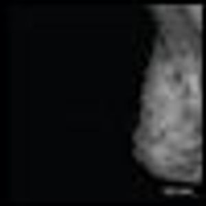 Early-Stage BRCA2-Linked Breast Cancer Diagnosed in the First Trimester of Pregnancy Associated With a Hypercoagulable State