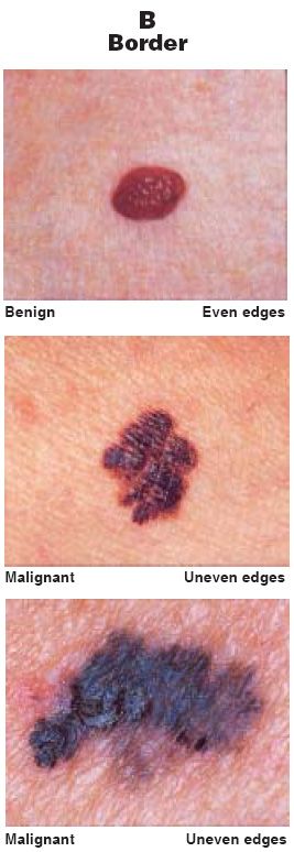 The ABCDs Of Moles And Melanomas