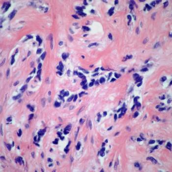 Sandra P. D’Angelo, MD, reviews current treatments in sarcoma, and how she interacts with her multidisciplinary counterparts to offer the best care to her patients. 