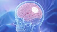 Adjuvant Radiotherapy Reduced Recurrence in Resected Atypical Meningioma: © 程 加星 - stock.adobe.com
