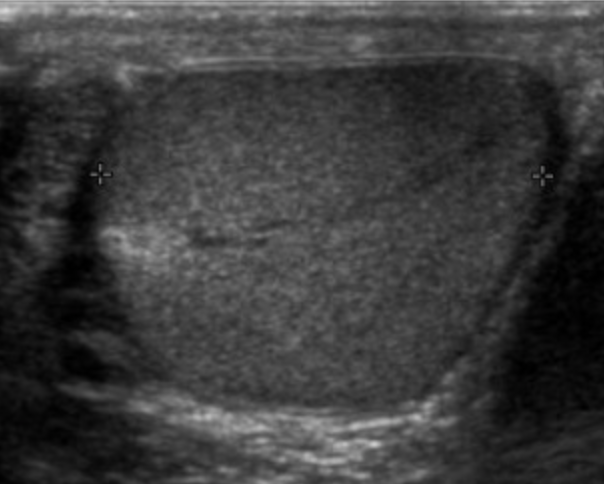 Sentinel Node Biopsy in Clinical Stage I Testicular Cancer