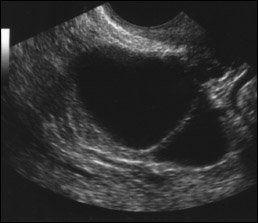 ovarian cancer tumor ultrasound