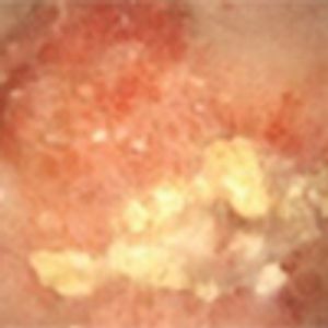 Gross Hematuria and Suspicious Bladder Lesions in a 52-Year-Old North African Immigrant