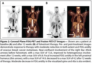 Using Nuclear Medicine Imaging in Clinical Practice: Update on PET to Guide Treatment of Patients With Metastatic Breast Cancer